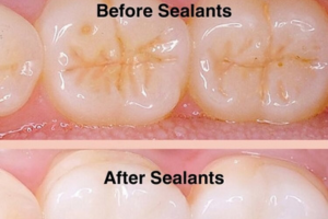 Dental-Sealants-Southwest-Edmonton